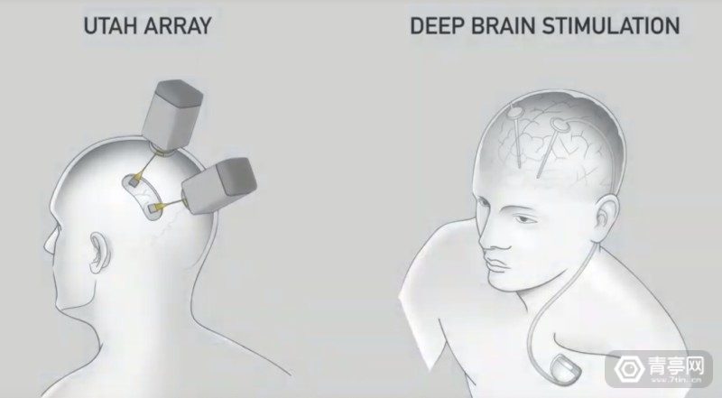 与AI共生：马斯克Neuralink的脑机接口梦