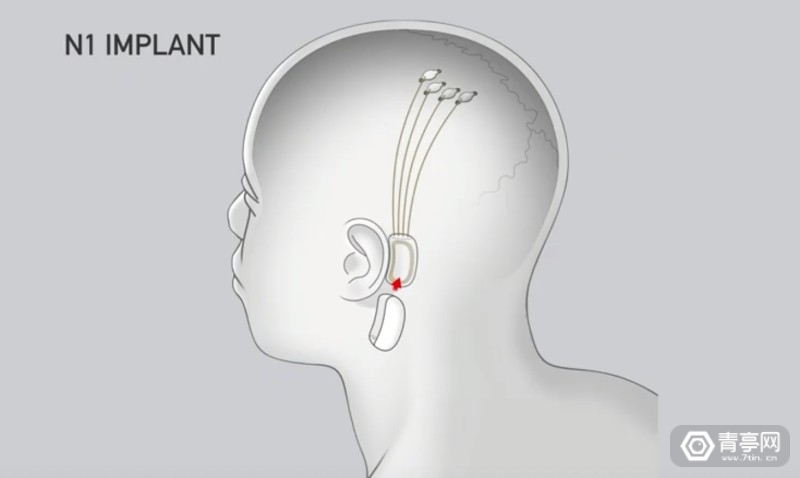 与AI共生：马斯克Neuralink的脑机接口梦